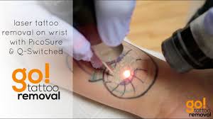 tattoo removal 1.jpg